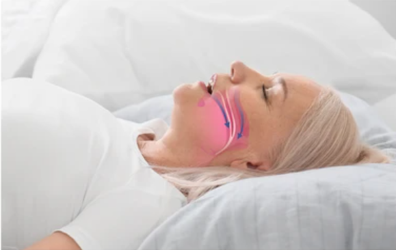 Sleep Apnea